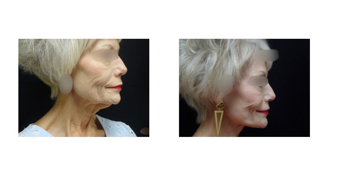 Facelift 1