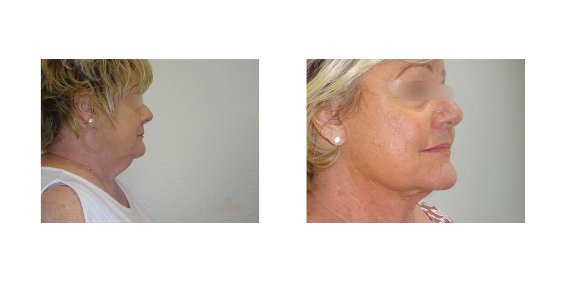 Facelift 2