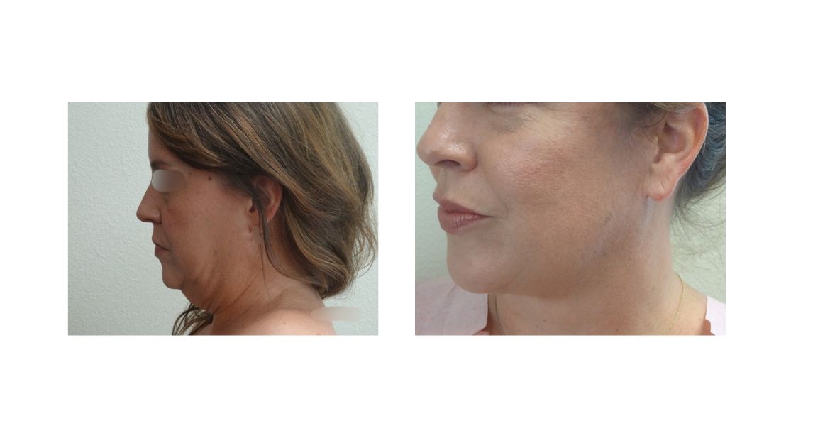 Facelift 3