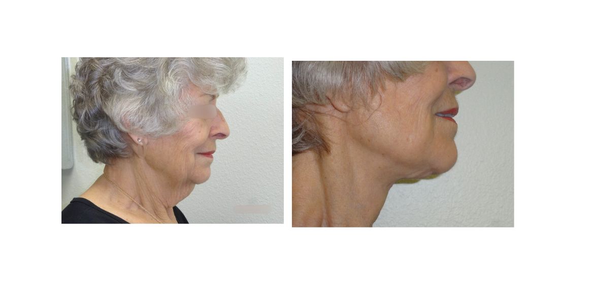 Facelift 4