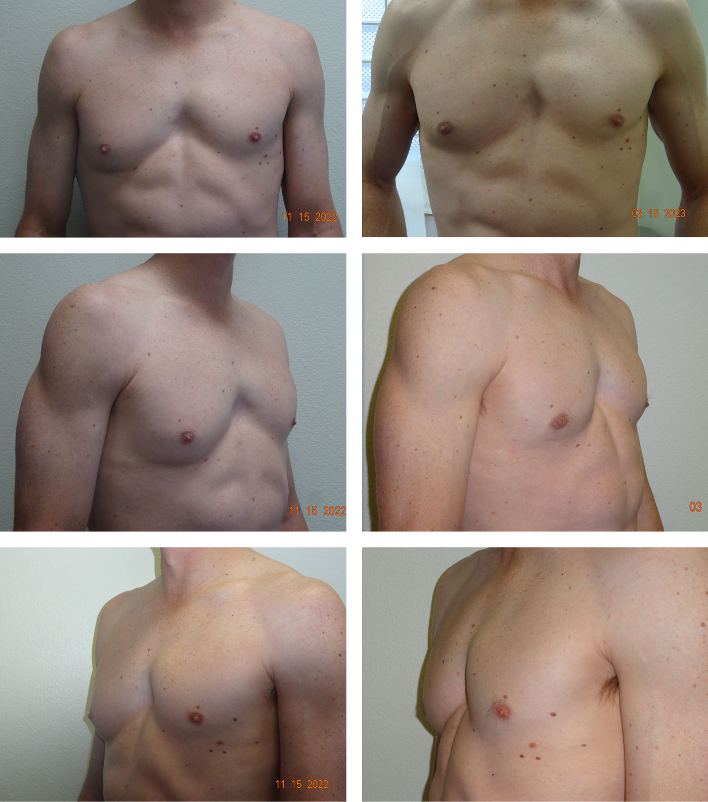 GynecomastiaSanAngelo